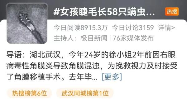 吓人!眼睫毛上爬着58条螨虫!有这些症状的注意了…… 吓人!眼睫毛上爬着58条螨虫!有这些症状的注意了……