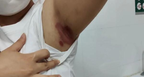 跳了一周“刘畊宏健身操”，妹子腋窝溃烂，又痒又痛