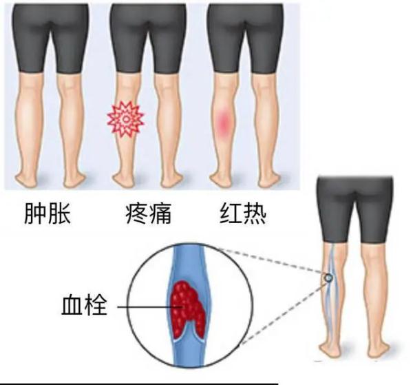 腿變粗了警惕下肢靜脈血栓