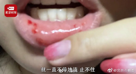 女生吃了半个菠萝嘴巴肿胀出血 医生:用盐水泡半小时再食用 女生吃了半个菠萝嘴巴肿胀出血 医生:用盐水泡半小时再食用