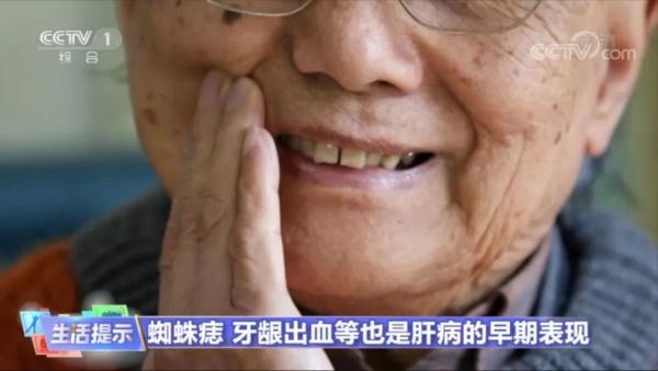 肝不好,看手掌?这些是肝脏发出的信号 肝不好,看手掌?这些是肝脏发出的信号