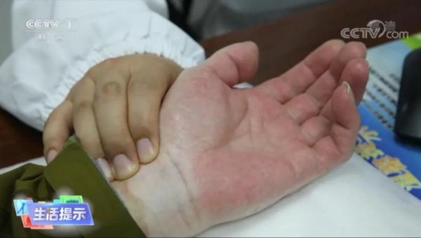 肝不好,看手掌?这些是肝脏发出的信号 肝不好,看手掌?这些是肝脏发出的信号