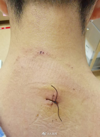 大爷脖子疼吃1个月止痛药肠穿孔
