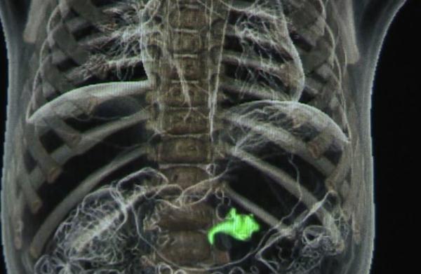 3岁女童误吞这种东西,肠子被磨穿5个洞!家长注意,这些物品一定要保管好! 3岁女童误吞这种东西,肠子被磨穿5个洞!家长注意,这些物品一定要保管好!