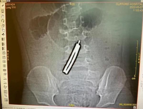 3岁女童误吞这种东西,肠子被磨穿5个洞!家长注意,这些物品一定要保管好! 3岁女童误吞这种东西,肠子被磨穿5个洞!家长注意,这些物品一定要保管好!