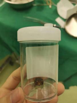 3岁女童误吞这种东西,肠子被磨穿5个洞!家长注意,这些物品一定要保管好! 3岁女童误吞这种东西,肠子被磨穿5个洞!家长注意,这些物品一定要保管好!