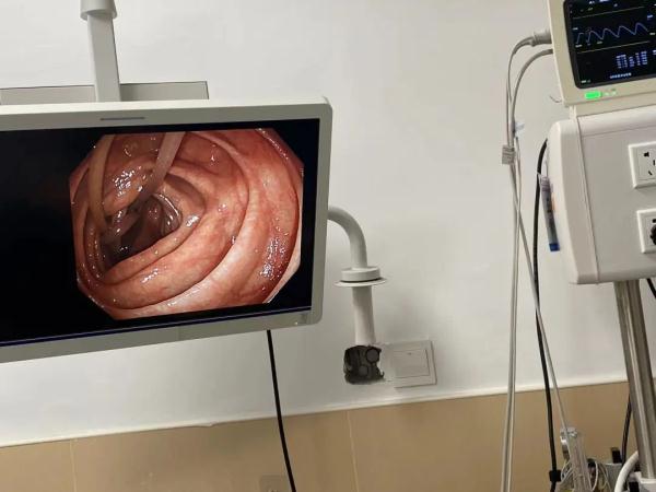 杭州阿姨肠子里有一团蛔虫个头比筷子还粗只因喜欢吃