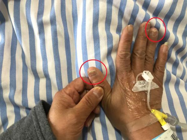 花了2万多元治灰指甲，浙江一大姐竟…医生提醒！