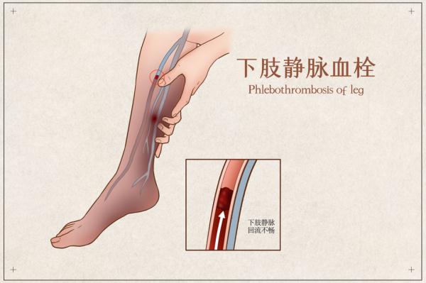 99的血栓无征兆这七种人更容易得血栓赶快每天转脚赶跑血栓