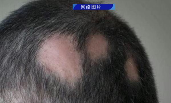 20多岁小伙硬生生把自己拔成“秃头”，真相令人唏嘘
