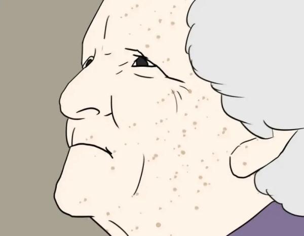 更年期未到,“老人斑”先来怎么办? 更年期未到,“老人斑”先来怎么办?