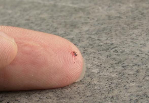 海南人注意!有人被咬后进急诊,这“小虫”公园、路边常见 海南人注意!有人被咬后进急诊,这“小虫”公园、路边常见