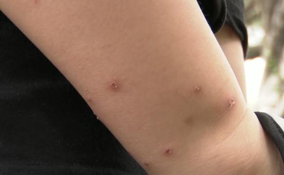 海南人注意!有人被咬后进急诊,这“小虫”公园、路边常见 海南人注意!有人被咬后进急诊,这“小虫”公园、路边常见