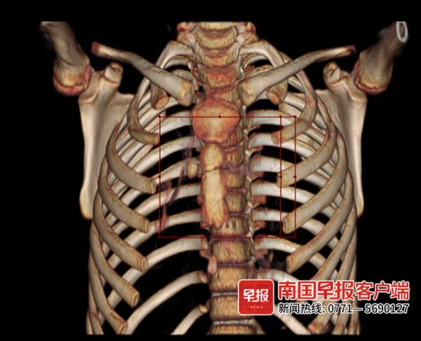 桂林9岁男孩误吞积木配件引肺部感染!医生:这种情况需注意 桂林9岁男孩误吞积木配件引肺部感染!医生:这种情况需注意