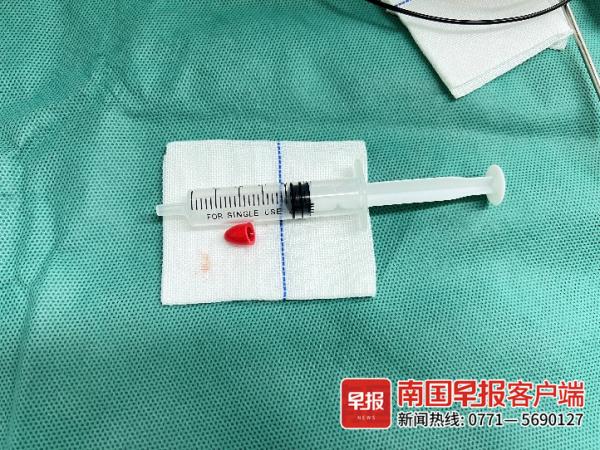 桂林9岁男孩误吞积木配件引肺部感染!医生:这种情况需注意 桂林9岁男孩误吞积木配件引肺部感染!医生:这种情况需注意