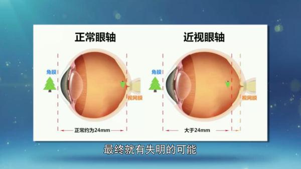 眼科专家透露“治疗近视”真相：近视手术不能治愈近视！