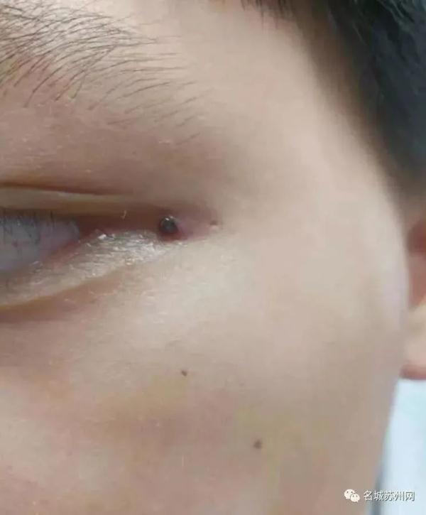 严重可致命！苏州疾控重要提醒！