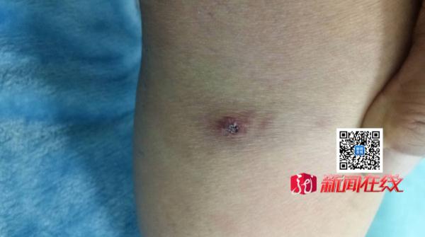 紧急提醒！已有3人死亡！这种虫子，黑龙江常见！