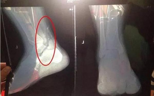 抖腿是病，还是毛病？有人把自己抖进了医院？吓得我赶紧摁住了腿......