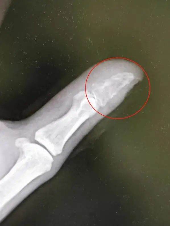 男子手指被小狗咬伤,一个月后指骨被细菌吃空...... 男子手指被小狗咬伤,一个月后指骨被细菌吃空......