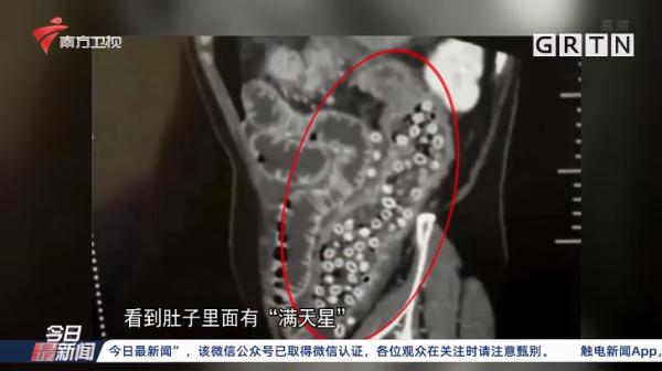 警惕！广州女子吃杨梅不吐核腹中“满天星”