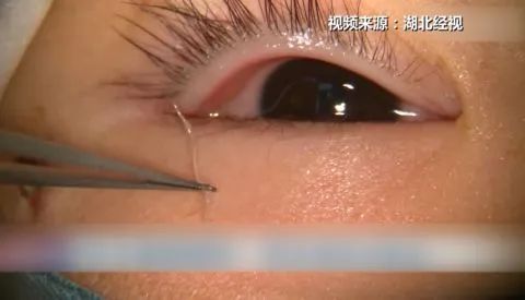 眼睛里惊现4条活虫，当心！