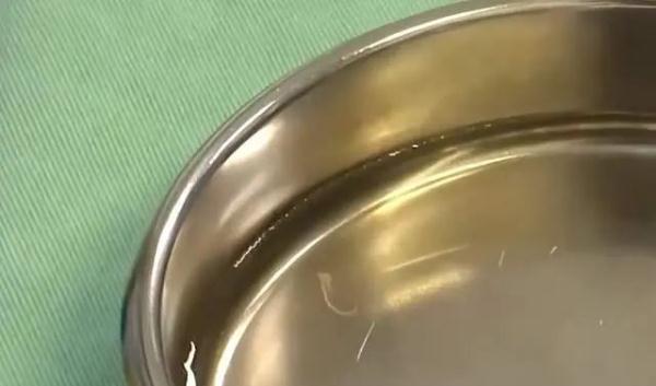 眼睛里惊现4条活虫，当心！