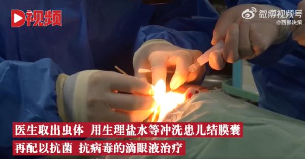 眼睛里惊现4条活虫，当心！