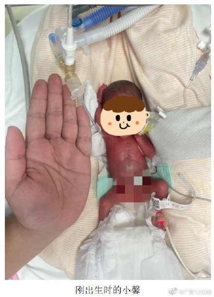 438克广州成功救治的最低体重早产儿今日出院