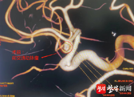 爸爸辅导孩子作业气到脑出血 爸爸辅导孩子作业气到脑出血