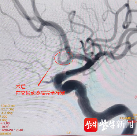爸爸辅导孩子作业气到脑出血 爸爸辅导孩子作业气到脑出血
