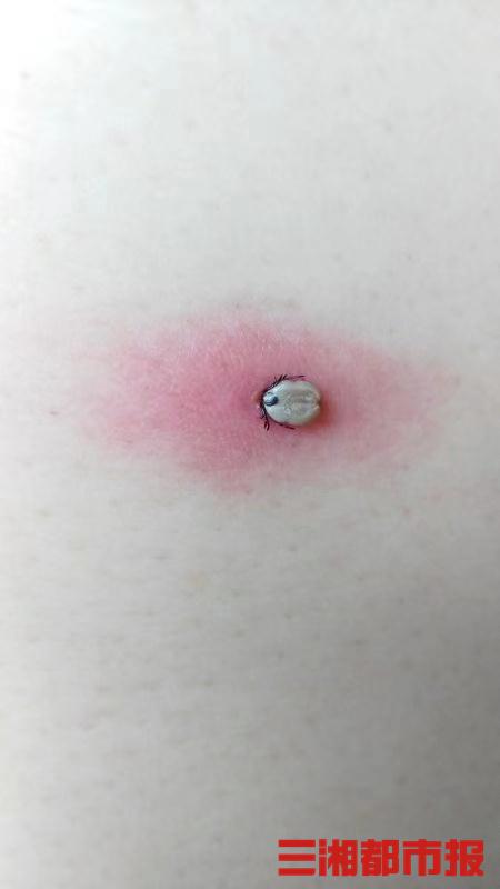 妈妈以为是颗痣!9岁女孩被蜱虫钻进头皮吸血一个多月 妈妈以为是颗痣!9岁女孩被蜱虫钻进头皮吸血一个多月