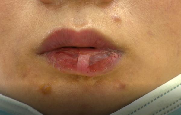 说好的“粉嫩嘟嘟唇”, 结果变成又肿又歪的“猪大肠”!美容院回复…… 说好的“粉嫩嘟嘟唇”, 结果变成又肿又歪的“猪大肠”!美容院回复……