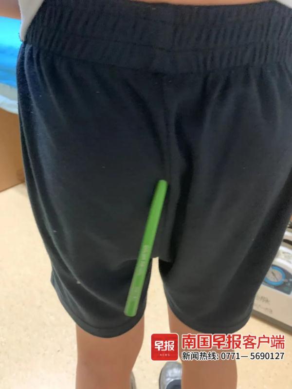 看着都痛！南宁9岁男童臀部被彩色铅笔插入，部分笔尖溶在体内