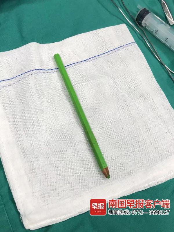 看着都痛！南宁9岁男童臀部被彩色铅笔插入，部分笔尖溶在体内