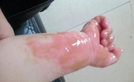 九月大男婴被热汤淋下,全身烫伤!妈妈含泪急奔上珠海大道…… 九月大男婴被热汤淋下,全身烫伤!妈妈含泪急奔上珠海大道……