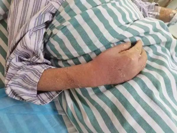 生吃三文鱼险丧命 感染了什么细菌这么吓人