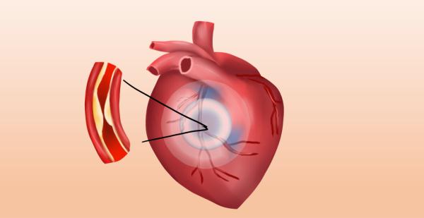 心梗来临前，身体会有这些征兆，5个建议给你的心脑“消暑降温”