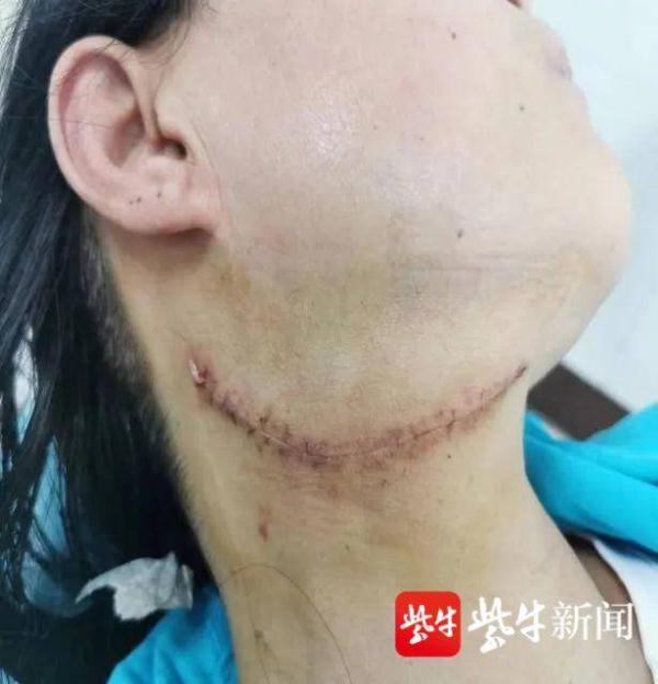 现实版济公割瘤寄居女子脖子六年巴掌大瘤子被成功切除