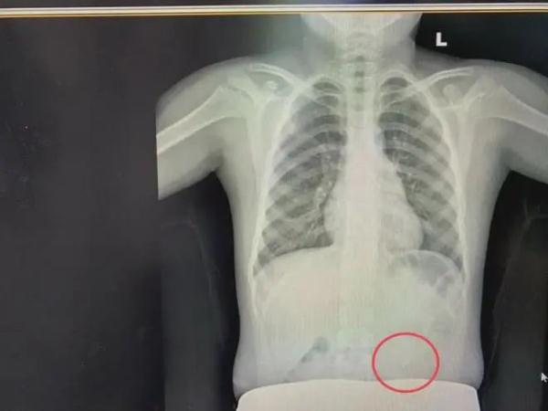 口罩竟成危险物？8岁男孩因此进了医院