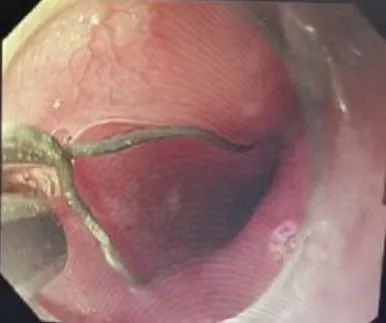 口罩竟成危险物？8岁男孩因此进了医院