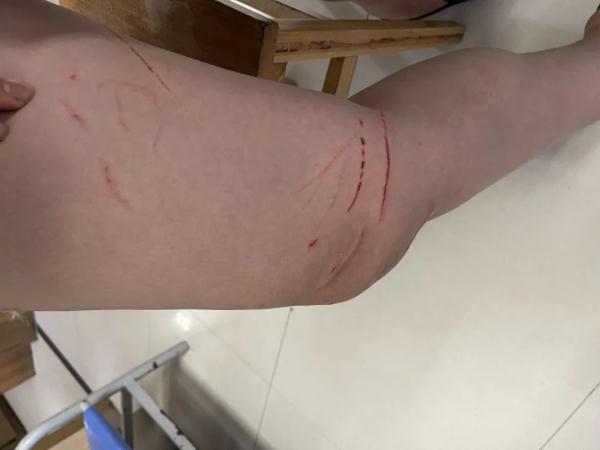 一个周末接诊近200人次，都跟它们有关！医生提醒：近期高发，要注意……
