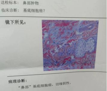 黑痣确诊恶性肿瘤，杭州阿姨后怕不已：差点就晚了！身上这些痣，一定盯紧…