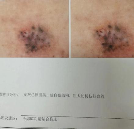 黑痣确诊恶性肿瘤，杭州阿姨后怕不已：差点就晚了！身上这些痣，一定盯紧…