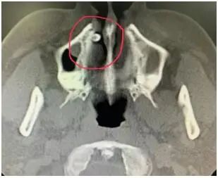 极其罕见!男子鼻子里竟长了颗牙? 极其罕见!男子鼻子里竟长了颗牙?