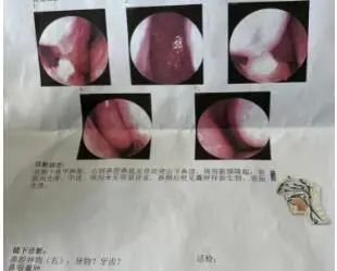 极其罕见!男子鼻子里竟长了颗牙? 极其罕见!男子鼻子里竟长了颗牙?