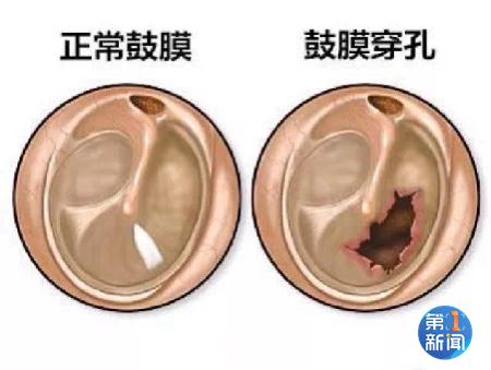 一巴掌没有拍死蚊子 男子把自己左耳鼓膜“打”穿孔