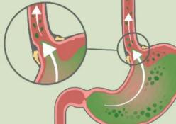吃饭咳、躺下咳、半夜还咳,到底啥原因? 吃饭咳、躺下咳、半夜还咳,到底啥原因?