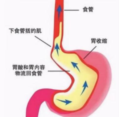 吃饭咳、躺下咳、半夜还咳,到底啥原因? 吃饭咳、躺下咳、半夜还咳,到底啥原因?