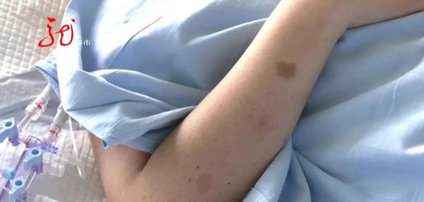 5000ml血液喷涌而出,哈尔滨一“熊猫血”女子突发血管破裂 5000ml血液喷涌而出,哈尔滨一“熊猫血”女子突发血管破裂